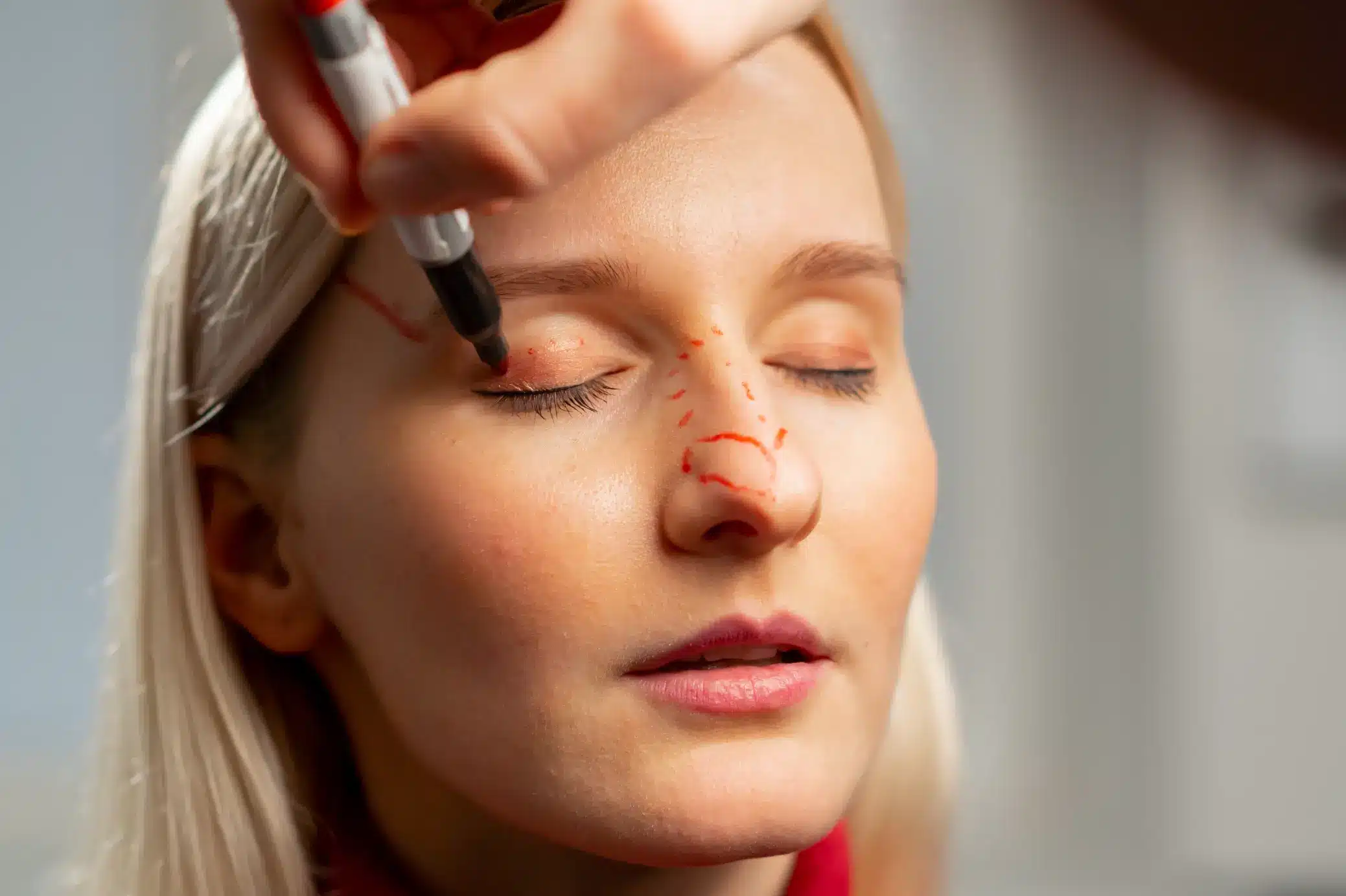 Bursa Revizyon burun estetigi