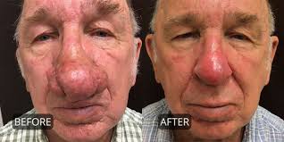 rhinophyma