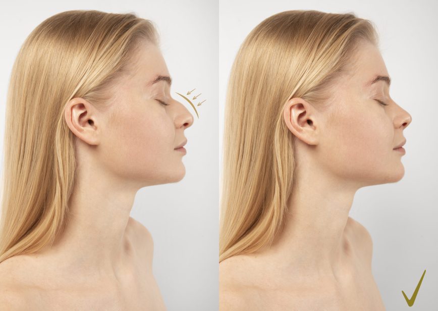 burun estetiği Dr Önder Akdeniz