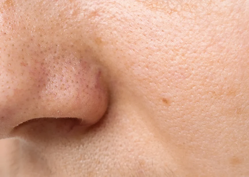 Wide Nose Rhinoplasty